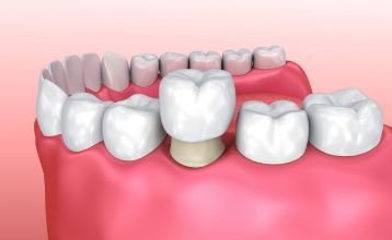 3D graphic of a crown being put on a molar