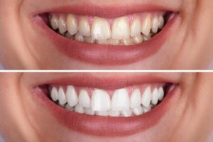 before and after teeth whitening photo
