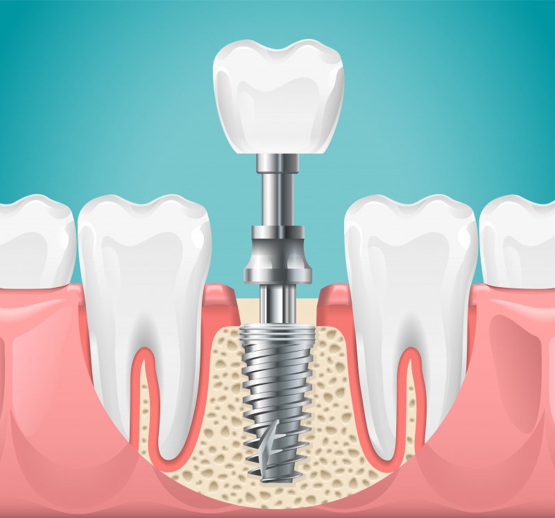 illustration of dental implant in Powdersville