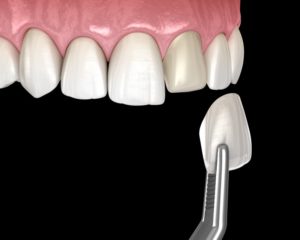 veneers 3D illustration 