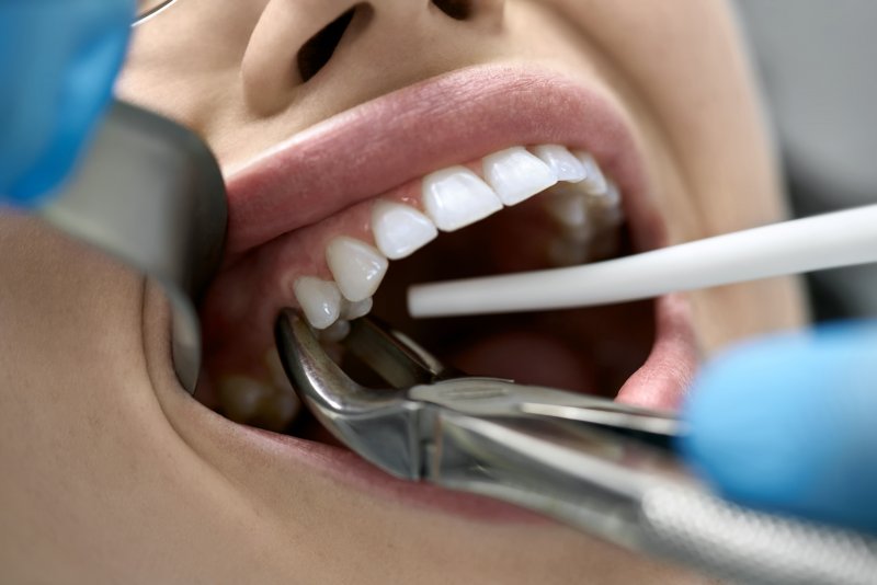 A dentist performing tooth extractions