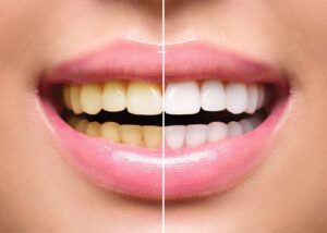 Comparison before and after teeth whitening.