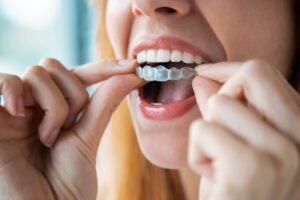 Woman fitting clear aligner on teeth.
